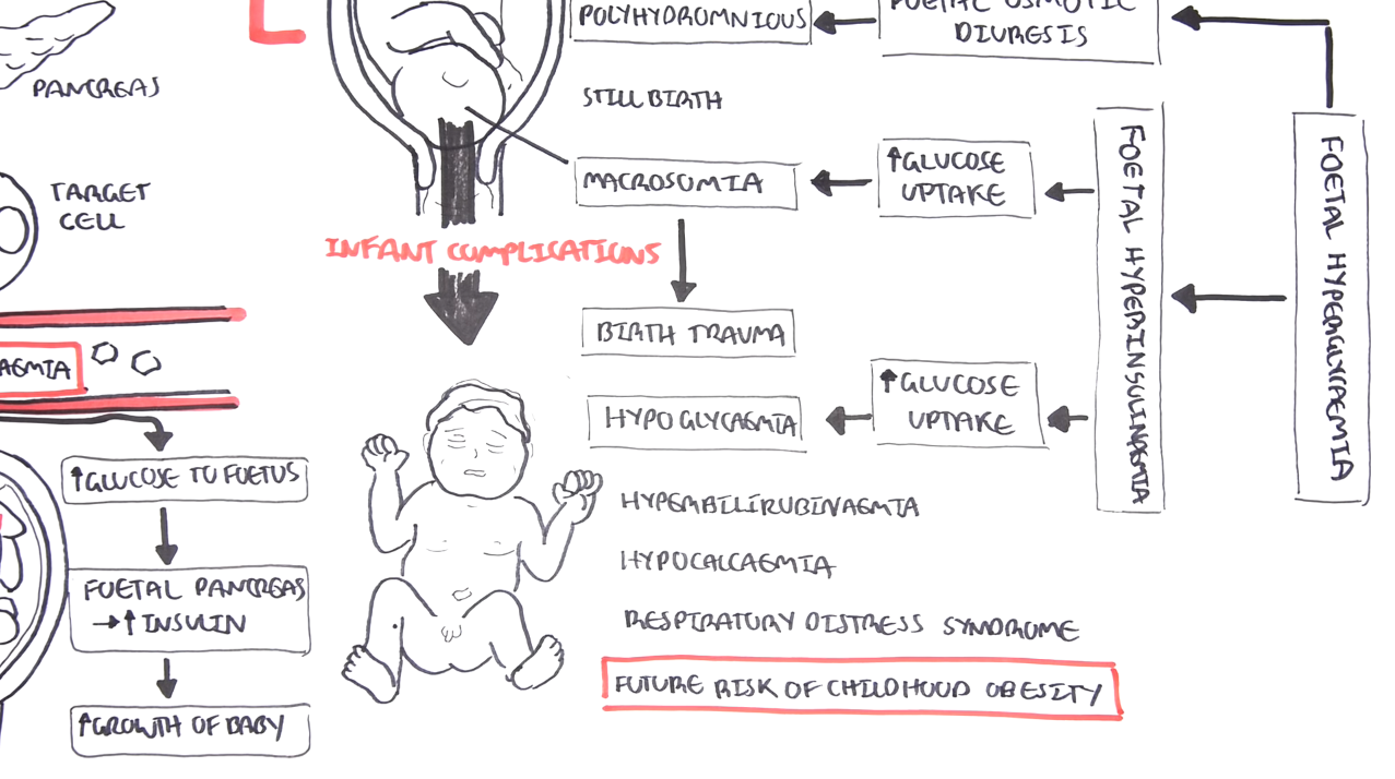 Gestational-Diabetes